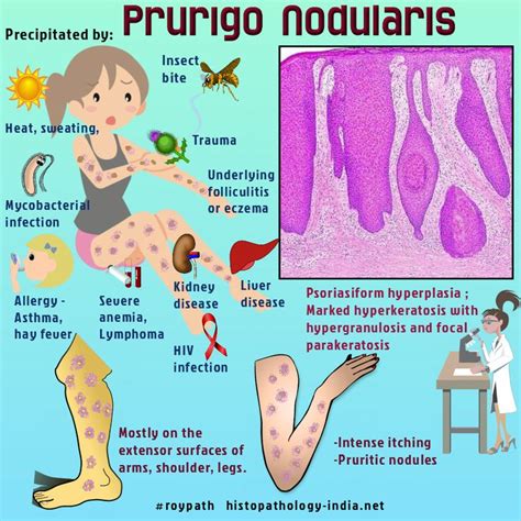 Prurigo Nodularis | Intense itching, Pathology, Skin disorders