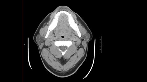 Normal CT neck - YouTube