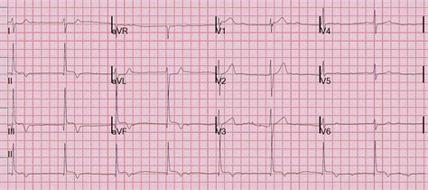 Dr. Smith's ECG Blog: What kind of AV block is this?? And where is the coronary occlusion??