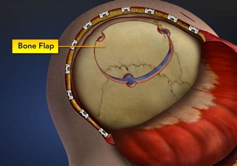 Craniotomy and Craniectomy: Life Saving Brain Surgery