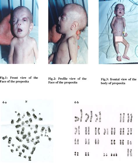 Figure 4 from MOSAIC TRISOMY 22 IN A MALFORMED NEWBORN FEMALE : A NEW CASE | Semantic Scholar