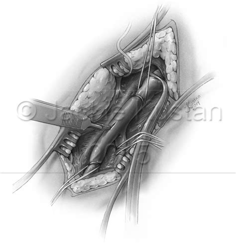 Femoral-femoral Bypass – Jackie Kustan, Medical Illustration