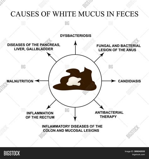 Mucus In Stool Human