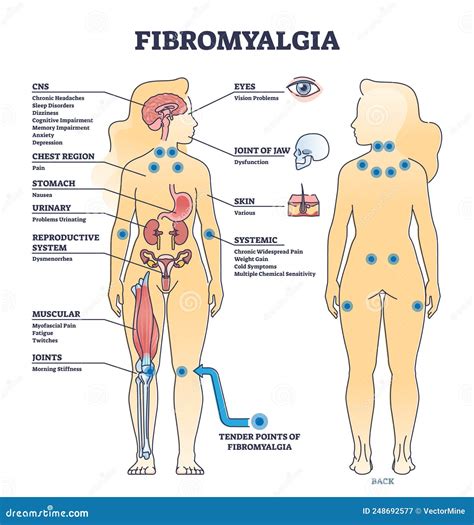 Fibromyalgia Vector Illustration. Diagnosis Symptoms Labeled Diagram ...