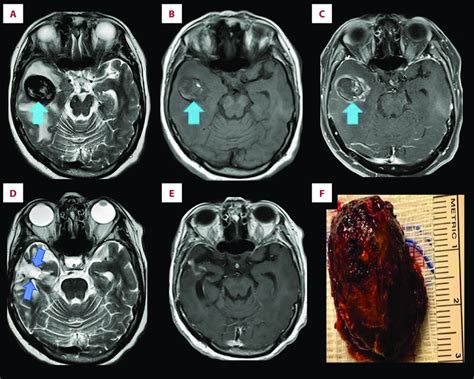 (A) Preoperative brain MRI, T2, showing mixed hyper-and hypointense... | Download Scientific Diagram