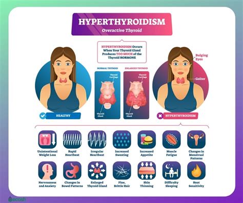 OVERACTIVE THYROID (HYPERTHYROIDISM) - Symptoms, Causes, Risk Groups and Treatment - Ecosh