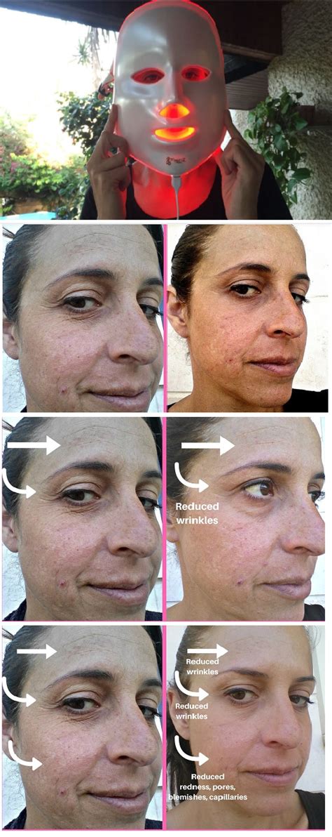 We Tried the Project E Beauty LED Face Mask for 30 Days (Results are In) | Light therapy mask ...