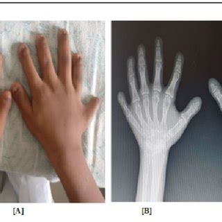 A] Six fingers in each hand B] X ray hand showing short metacarpals ...