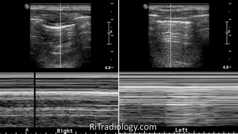 RiT radiology: Pneumothorax on Ultrasound