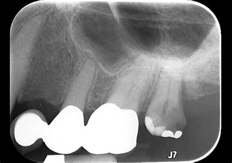 Periapical radiograph demonstrating a large carious lesion at no. 15... | Download Scientific ...