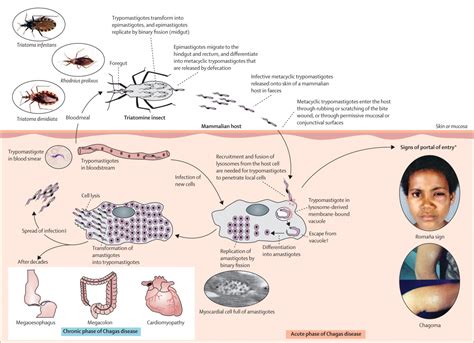 Chagas disease - The Lancet