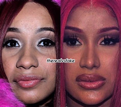 Cardi B: Before & After Nose Job & Fillers | Nose job, Botox fillers, Cosmetic surgery