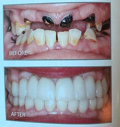 Full Mouth Rehabilitation - Dream Smile Dental