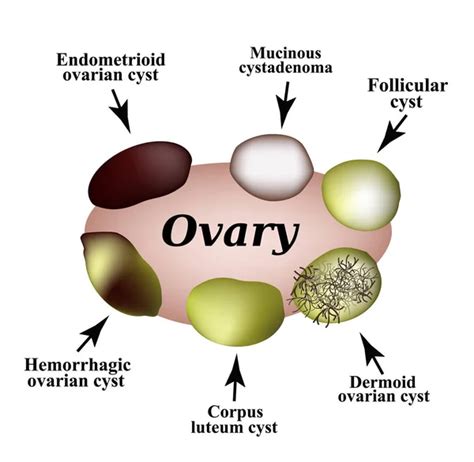 Ovarian Follicle Cyst