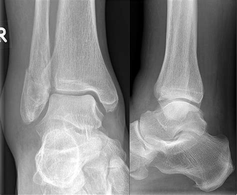 Displaced Trimalleolar Ankle Fracture