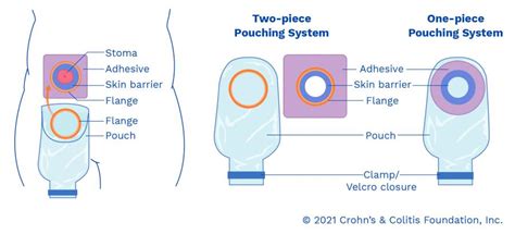 Types of Pouching Systems l United Ostomy Association Of America