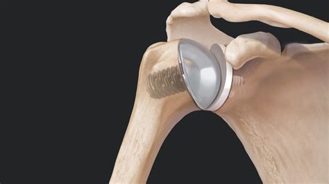 Arthrex - Eclipse™ Stemless Shoulder Arthroplasty System