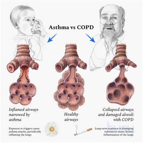 Both asthma and COPD are respiratory diseases, but they are different ...