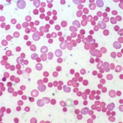 What is the Difference Between Intravascular and Extravascular Hemolysis | Compare the ...