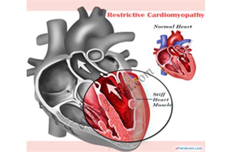 Restrictive Cardiomyopathy