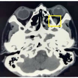 A thickened left inferior rectus muscle prior to treatment was observed ...