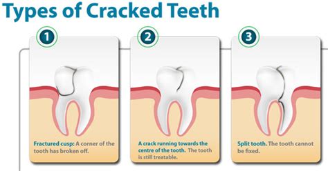 Chipped Back Tooth