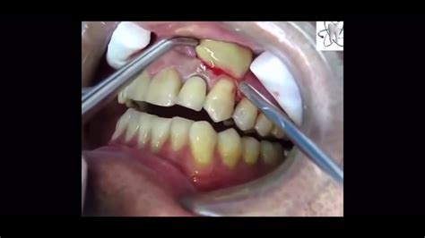 Skin Abscess Drainage