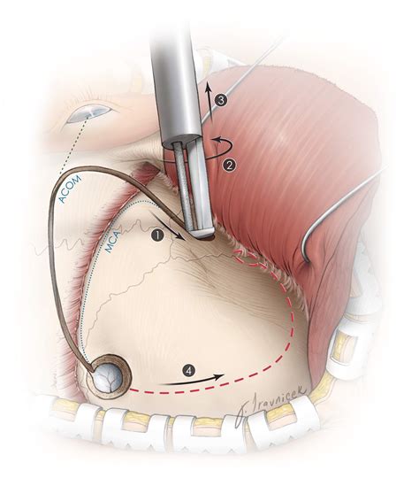 Pterional Craniotomy | The Neurosurgical Atlas