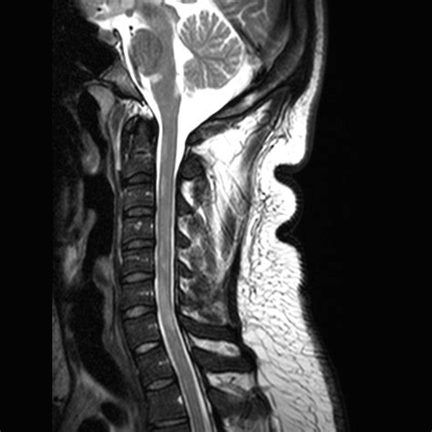 Diagnosing Multiple Sclerosis With MRI | AffordableMRI.com