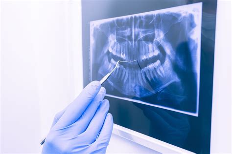 Insights Into Dental X-rays: Unveiling The Importance And Safety Measures