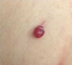 An 8-year-old girl with a bleeding red bump