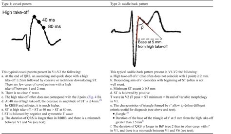 emDOCs.net – Emergency Medicine EducationBrugada Diagnostic Criteria ...