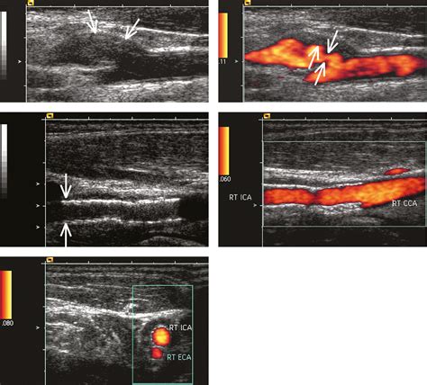 Figure 031_6082. Carotid ultrasonography: A , B-mode longitudinal image of the carotid sinus and ...