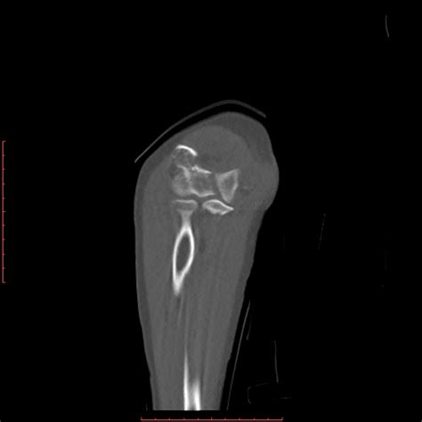 Distal humerus fracture - wikidoc