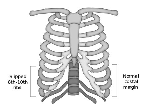 Floating Rib Syndrome Mayo Clinic