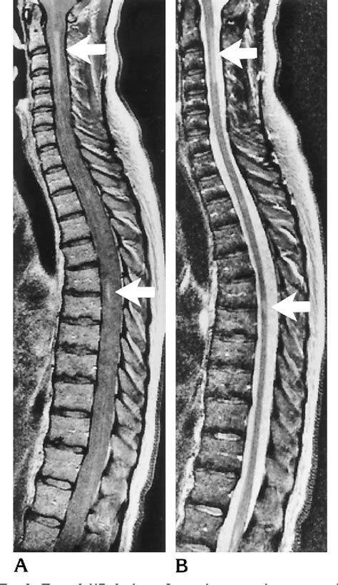 Figure 2 from MR of the spinal cord in multiple sclerosis: relation to ...