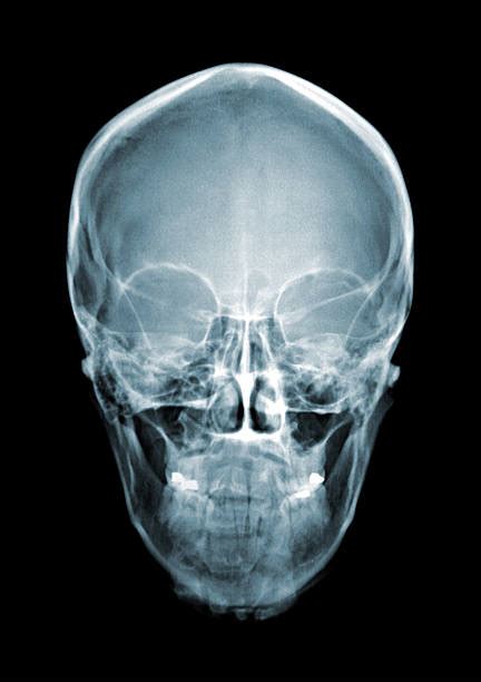 Fractured Eye Socket X Ray