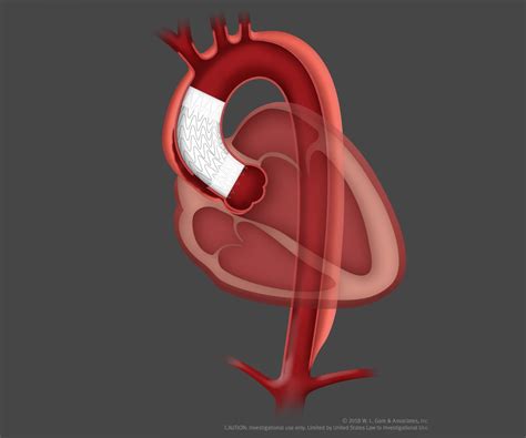 Gore Announces Successful Patient Implant of Endovascular Stent Graft for the Ascending Aorta | Gore