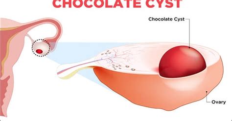 Ayurvedic Treatment for Chocolate Cyst - Dr. Vikram's Blog - Ayurvedic ...