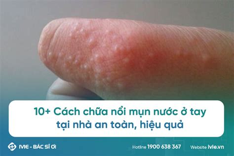 10+ Cách chữa nổi mụn nước ở tay tại nhà an toàn, hiệu quả