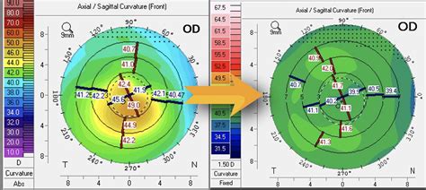 Advanced Keratoconus Treatment Brisbane — Dr David Gunn · Brisbane Ophthalmologist · Cornea ...