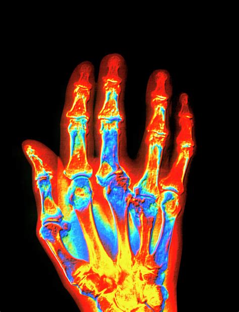 Coloured X-ray Of A Gout Sufferer's Hand Photograph by Alfred Pasieka/science Photo Library ...