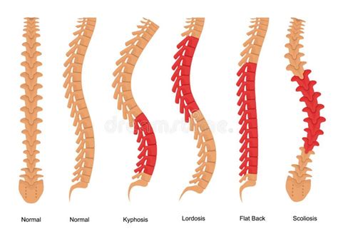 Spinal Deformity Types Stock Illustrations – 40 Spinal Deformity Types Stock Illustrations ...