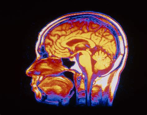 Increased Intracranial Pressure Symptoms and Causes