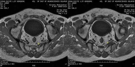 Pyriformis syndrome MRI | Piriformis muscle, Nerve entrapment, Sciatic ...