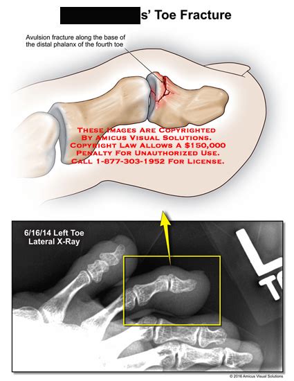 AMICUS Illustration of amicus,injury,radiology,x-ray,toe,fracture ...