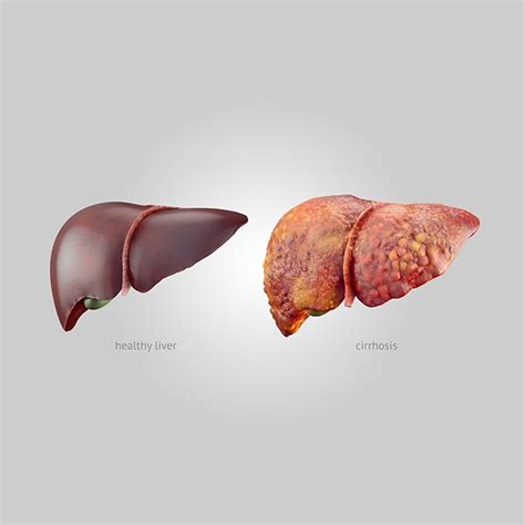 Cirrhosis - NIDDK