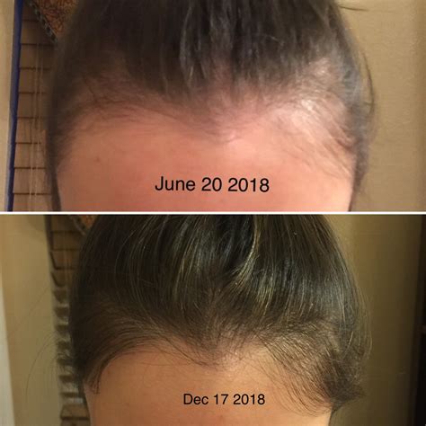 (f) 6 months Minoxidil and 4 months Niz : r/HairlossProgressPics