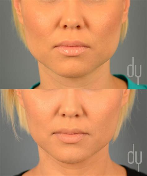 Botox for Masseter Reduction | Before + After | Jaw reduction with ...