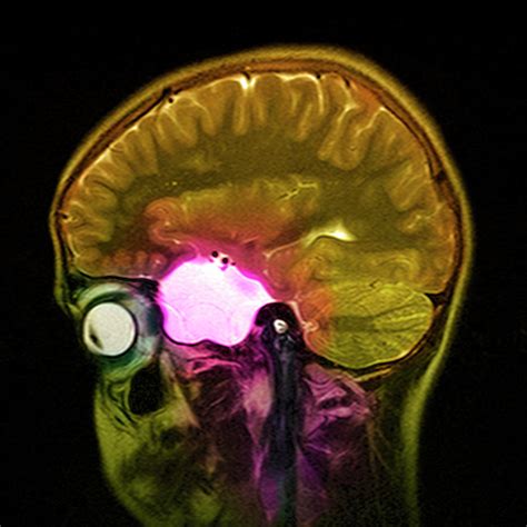 Arachnoid Cyst Photograph by Simon Fraser/science Photo Library - Fine ...